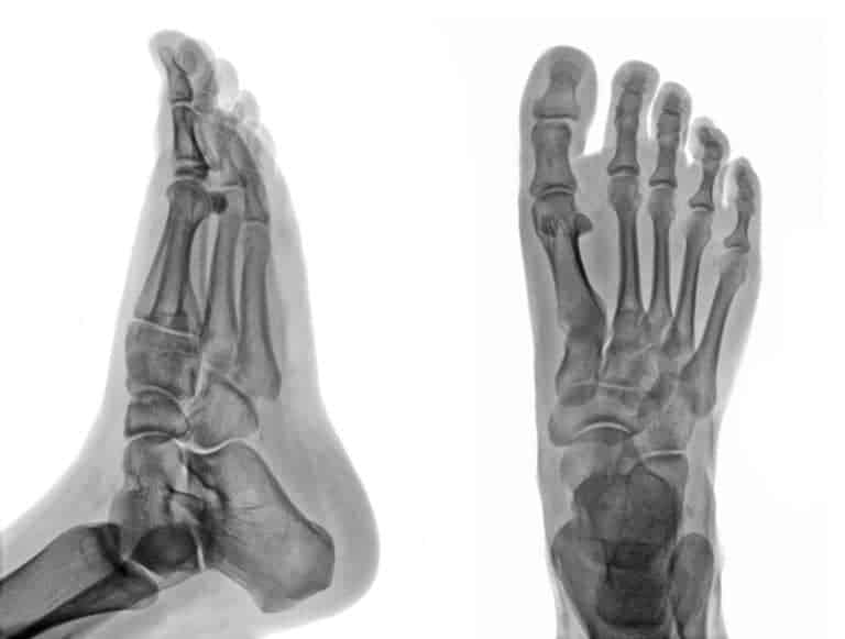 How to Get Back to Running after Metatarsal Stress Fracture The Bodywise Clinic