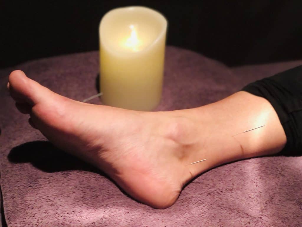 Acupuncture The Bodywise Clinic